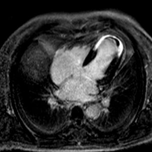 5.-LE_und_Thrombus-300x300