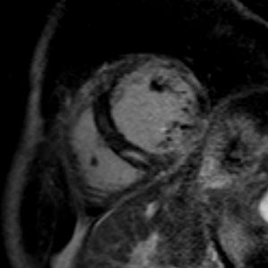 5.-Myocarditis-300x300